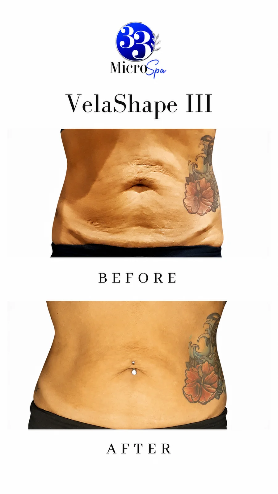 Body contouring before and after result 1