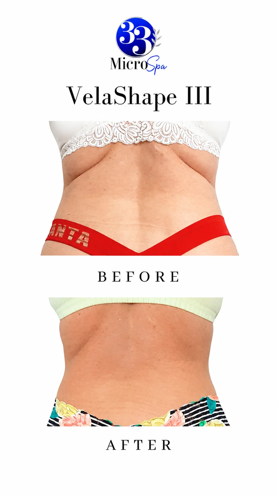 Body contouring before and after result 2
