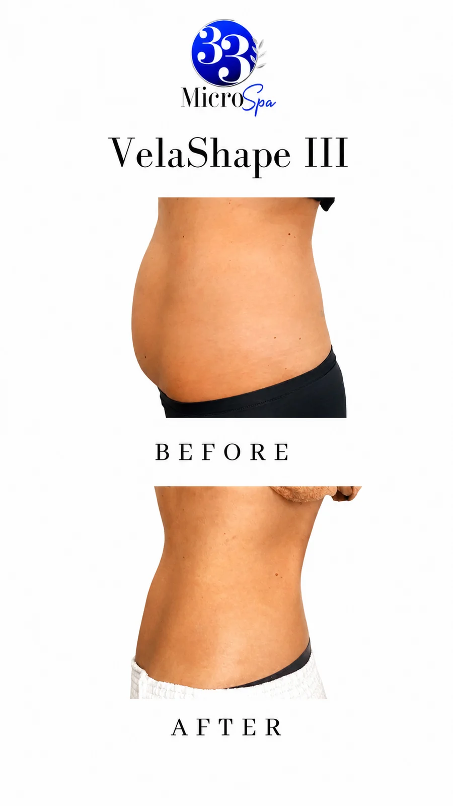Body contouring before and after result 3