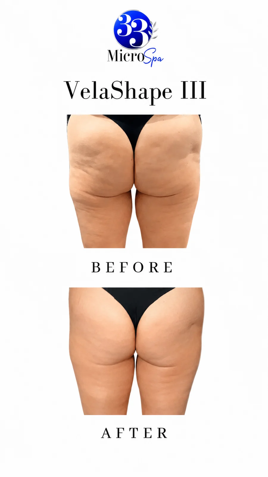 Body contouring before and after result 4