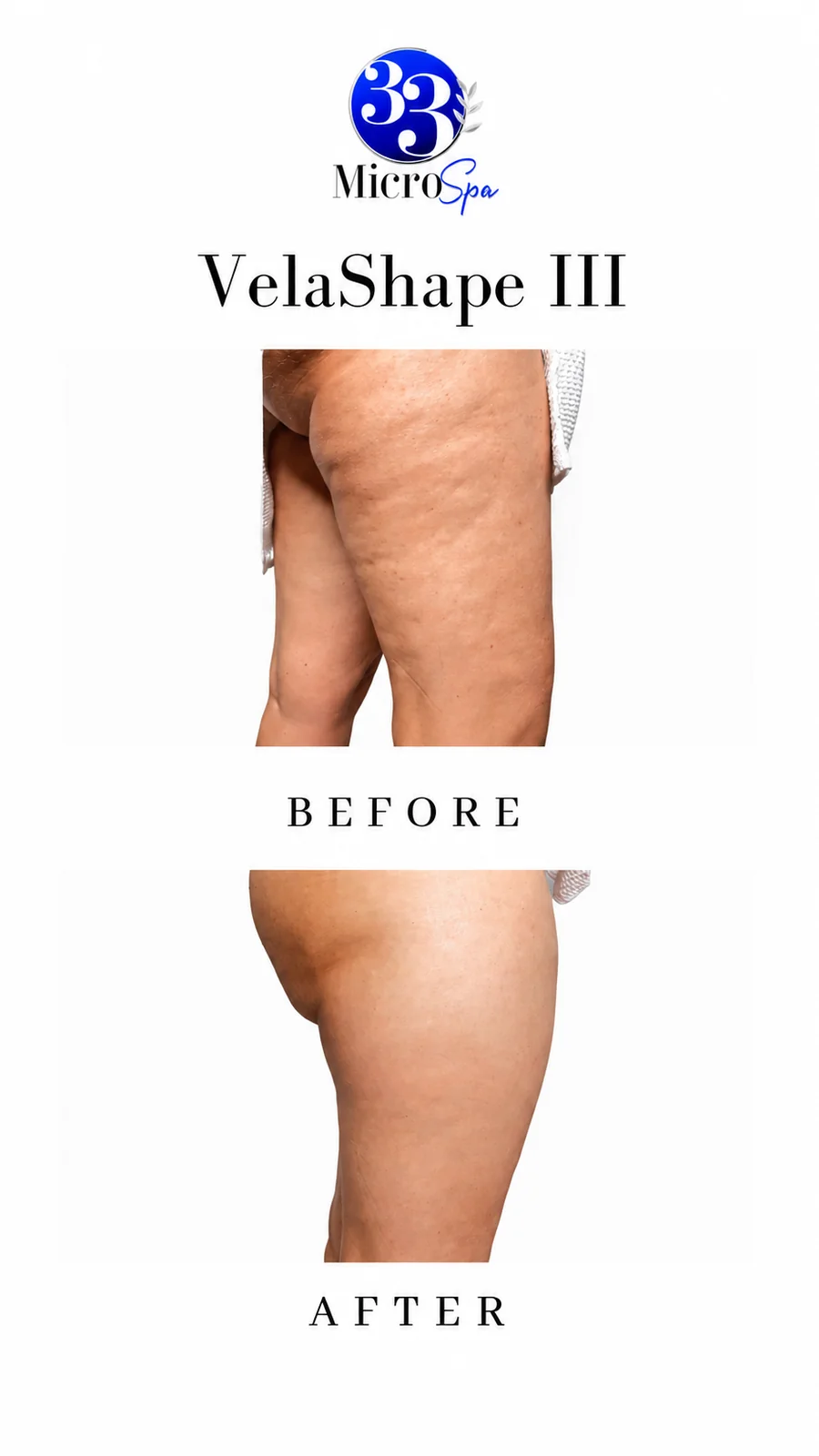 Body contouring before and after result 5
