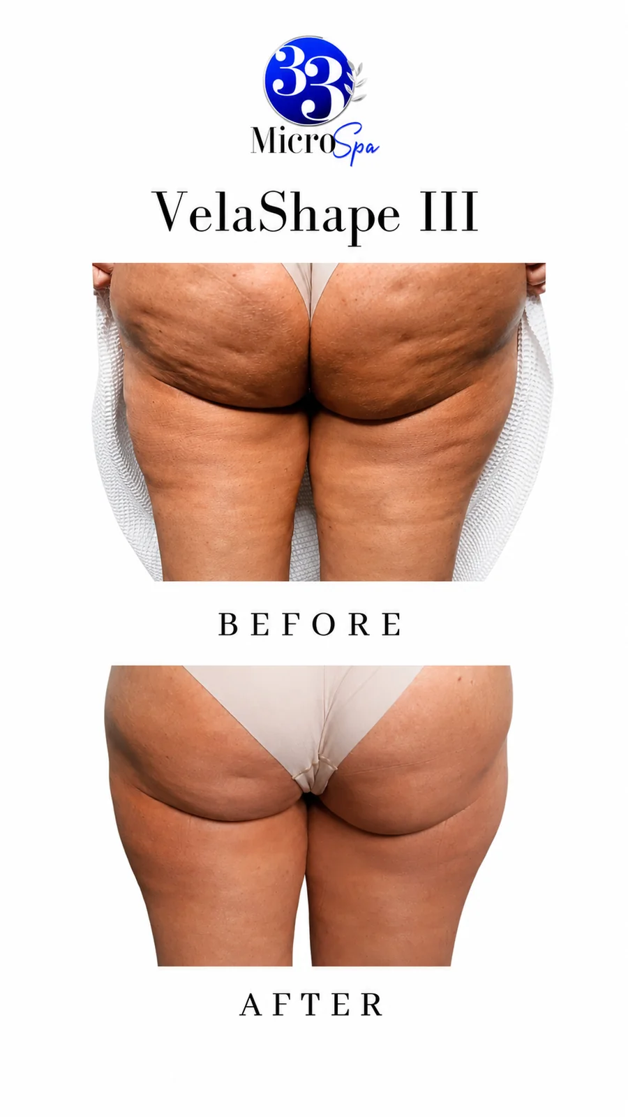 Body contouring before and after result 6
