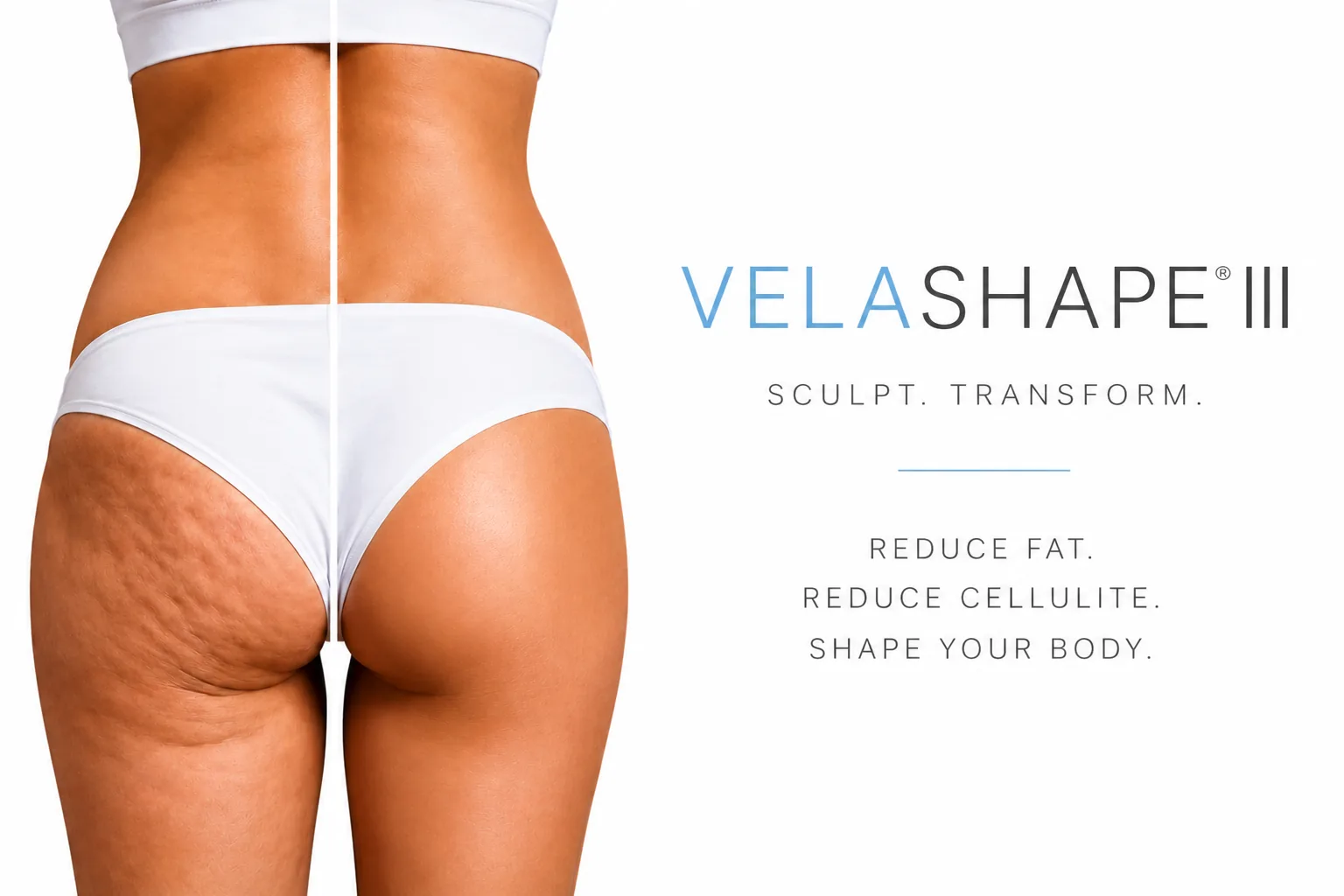 VelaShape body contouring treatment